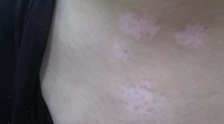 宝宝脖子白斑图片