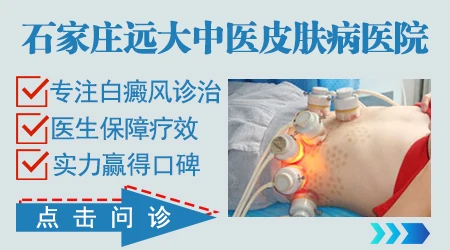 石家庄白癜风专科医院哪家口碑好