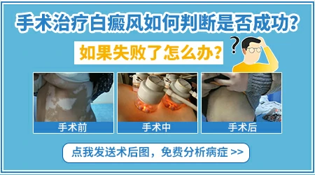 白斑表皮移植手术失败怎么补救