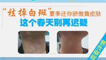 脖子长白斑可以植皮吗