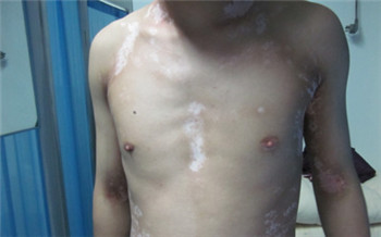 国内治疗白癜风医院排名 哪家医院看白癜风ZUI好