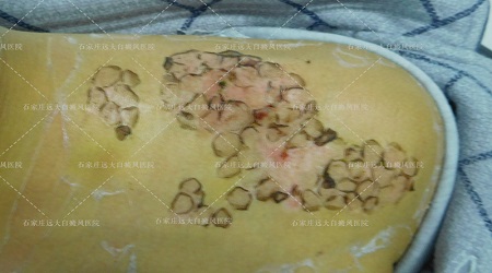 白癜风做完培埴后一周的样子