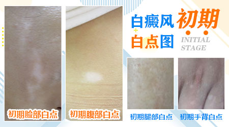 脸部白斑早期症状图片大全