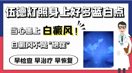 伍德灯检查白斑显示淡蓝色是白癜风吗
