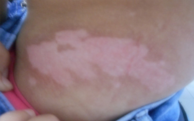 肚子上都是白癜风还能不能治好