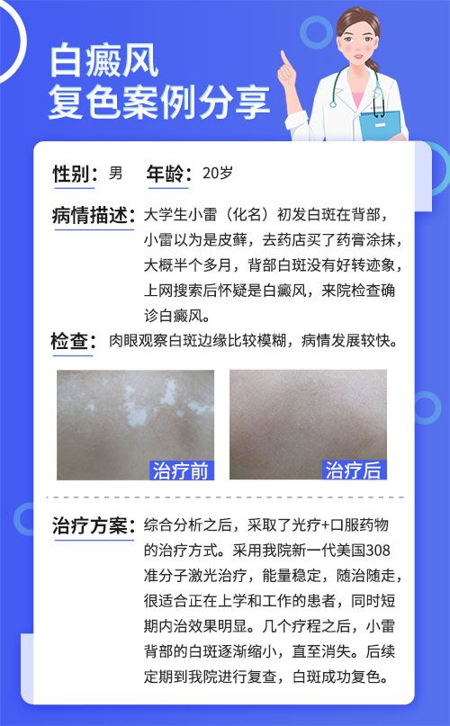 白癜风乳白色图片