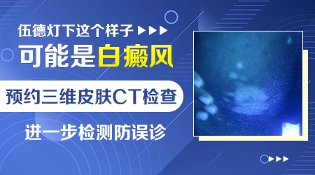 伍德灯检查能直接确诊白斑吗