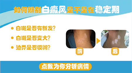 白癜风到什么程度才是达到稳定期