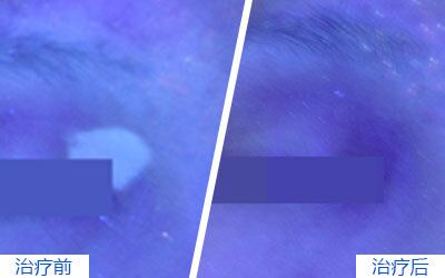 眼皮下面皮肤很浅发白是白癜风吗