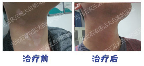 白癜风治疗前后的对比图