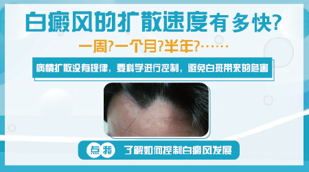 白癜风发作期扩散的快吗