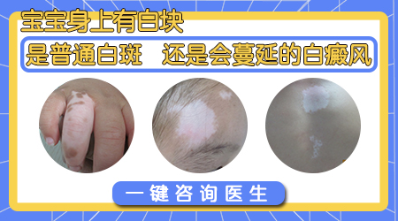 小孩身上有白斑图片 小儿白斑图