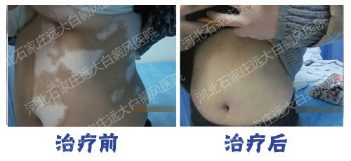 白癜风黑色素移植可以和原来皮肤一样吗