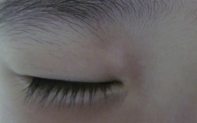 小孩眼角有淡淡的白斑怎么回事