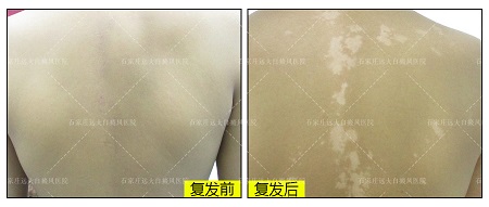 后背小米粒大小白点怎么回事