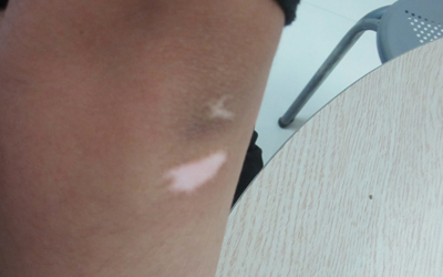 宝宝大腿内侧夹缝白 皮肤发白做哪些检查