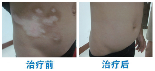 窄谱紫外线照白癜风多久出效果