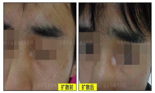 白斑用手搓不会变红 白斑可能是什么疾病