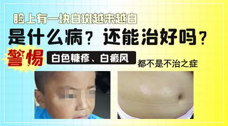 脸蛋上有光滑的白斑 不同类型白斑图片