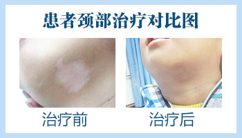 面部白癜风表皮移植后的样子