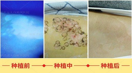 白癜风可以打色素针吗