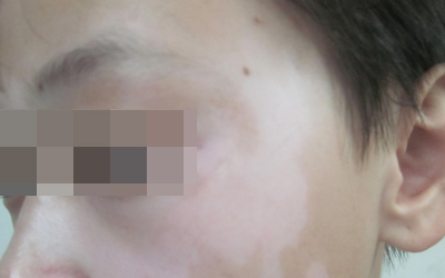 早期的面部白斑治疗多久能恢复