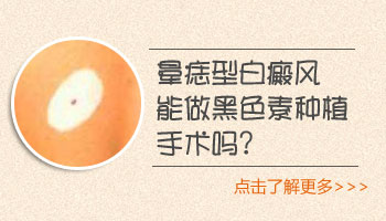 晕痣必须切除吗 切除白斑会扩散吗