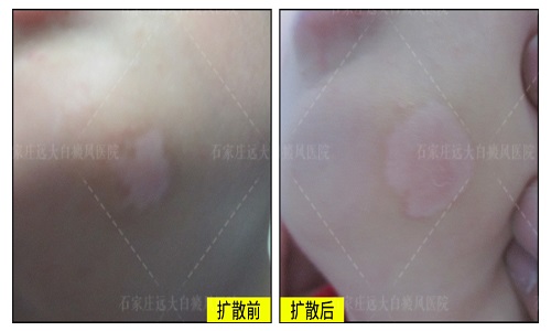 白斑出现扩散的原因是什么