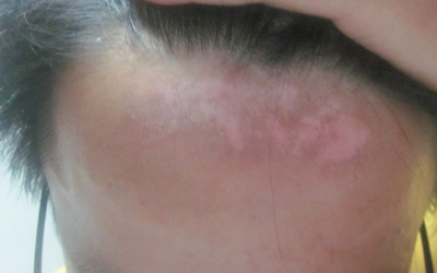 初期脸部白癜风的图片