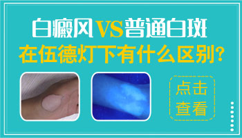 普通白斑图片 白癜风图片