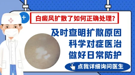 哺乳期白癜风扩散厉害怎么控制