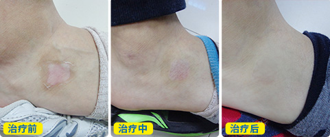 足部白癜风5年了如何治疗好
