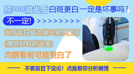 白癜风治疗一个月越来越白怎么回事