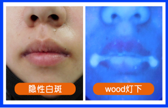 隐形白斑是怎么看出来的