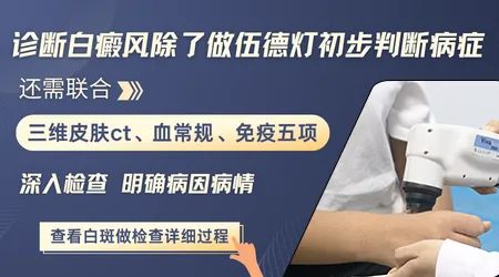 伍德灯下没荧光还有可能是白癜风吗