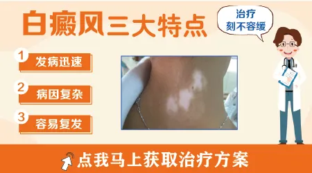 白癜风是自身免疫性疾病吗