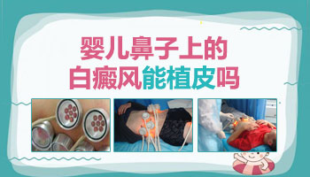 婴儿白斑图片与白癜风区别