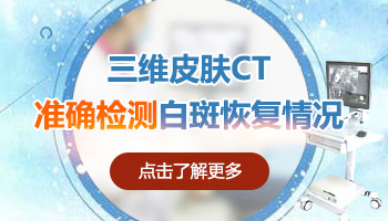 伍德灯照射结果是有点白是白癜风吗