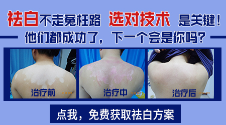 白癜风照311光疗能照好吗