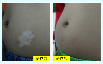 白癜风有治好几十年不复发的案例吗