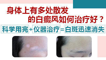 白癜风会不会有的在痊愈有的在扩大