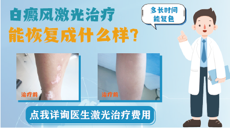 小孩白癜风能照激光吗 308激光费用大概多少