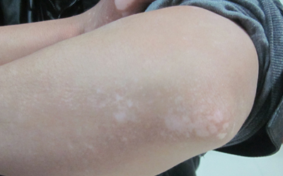 白癜风关节处白斑怎么治疗好