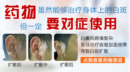 白癜风辅助药都是哪些药物