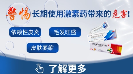 白癜风外涂激素药膏能用多久