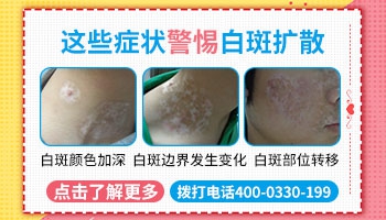 白癜风在1年内没扩散还会扩散吗