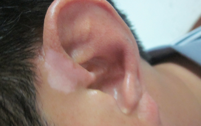 耳朵后面有块皮肤发白是怎么了