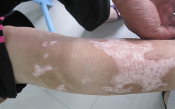 8岁小孩手臂上出现小白点图片