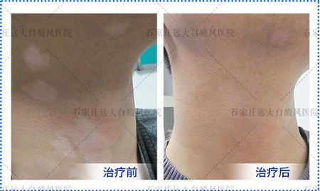 白癜风患者怎么补充络氨酸酶