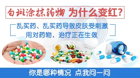 白癜风抹他克莫司软膏变红是好现象吗
